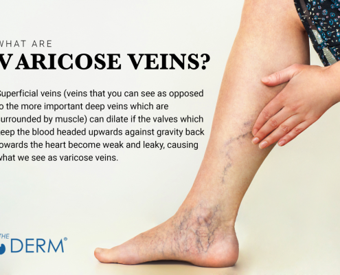 what are varicose veins 1 1536x1028 1
